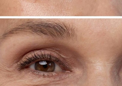 Dermal Fillers: A Guide to Enhancing Your Look
